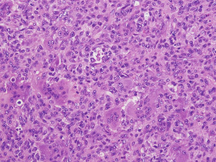 2 Case Reports in Medicine Figure 1: Histology of hemipelvectomy specimen showed mononuclear cells with interspersed multinucleated cells (hematoxylin and eosin stain, 20x).