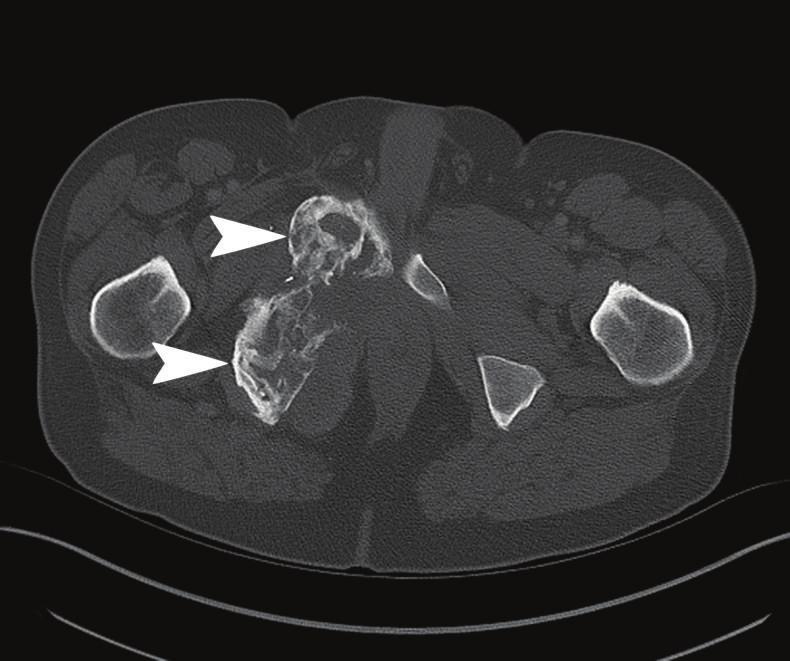 Initial imaging is unavailable but by report radiographs showed a large mass involving the ischial tuberosity and portions of the adjacent inferior and superior rami of the right pelvis.