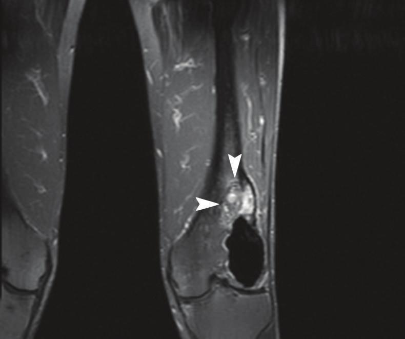 Case Reports in Medicine Figure 11: Distal femoral amputation demonstrated an ill-defined mass (arrows) proximal to the PMMA packing.