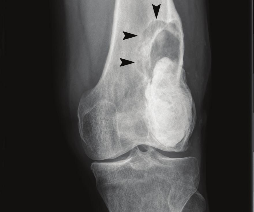 Figure 9: Coronal T1 postcontrast CT (November 2013) demonstrated a heterogeneously enhancing soft tissue mass (arrows) within the lateral aspect of the distal femoral condyle, proximal to the
