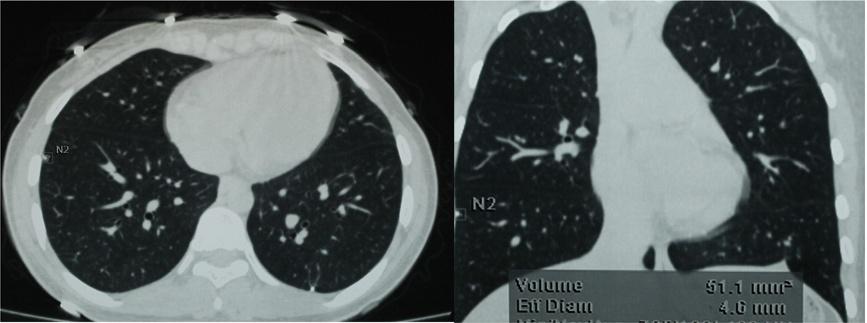 Muheremu and Niu World Journal of Surgical Oncology 2014, 12:261 Page 7 of 9 Figure 5 34 months after the first surgery, multiple nodules were found by CT scan in both of her lungs on a follow-up
