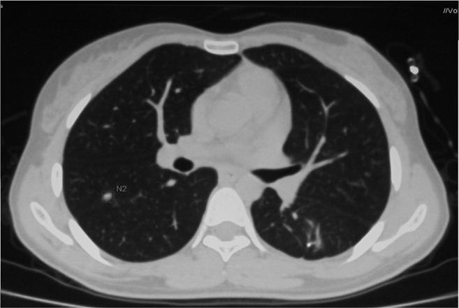 Prognosis For lung metastasis, appropriate surgical resection such as metastasectomy, wedge resection or lobectomy should be carried out if it is possible to prevent progressive pulmonary dysfunction