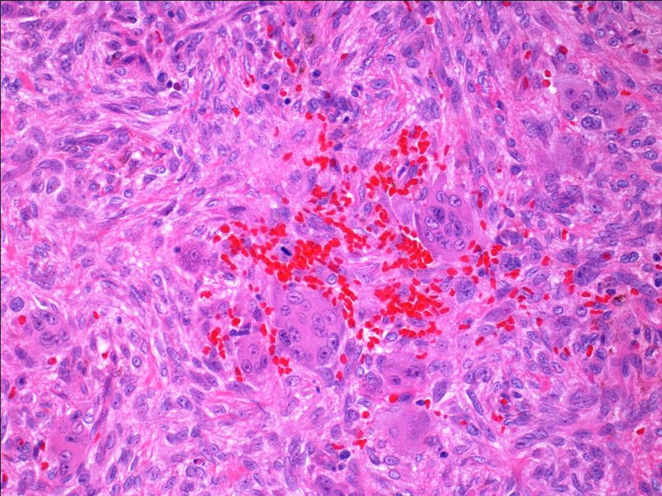 (B) Biphasic tumour morphology is apparent upon microscopy examination of the resection.