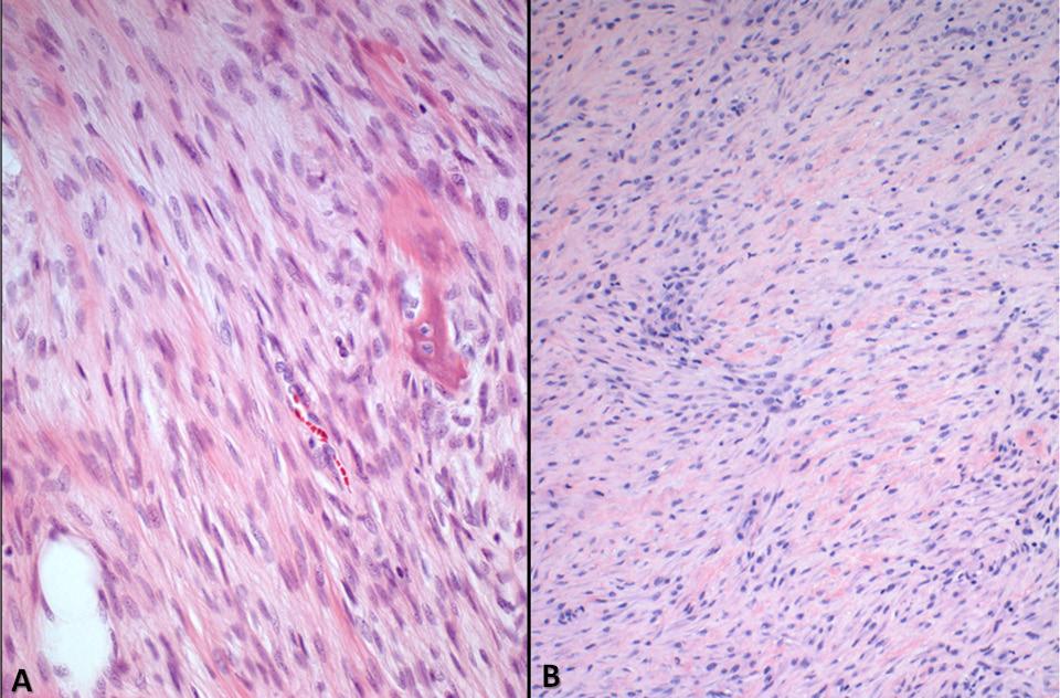 DEDIFFERENTIATED GIANT CELL TUMOUR OF BONE figure 4 In its most recent (2008) aggressive local recurrence, the dedifferentiated tumour is histologically similar to (A) the earlier (2006) recurrence.