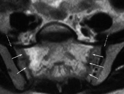 2T open MRI unit with axial spin echo (SE) T1 (Figure-2), coronal TSE T2 (Figure-3), and short tau inversion