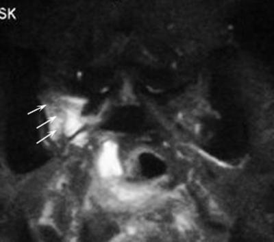 Figure 4 Figure 4 : Coronal STIR WI reveals the apparent hyperintense medullary edema on the right side.