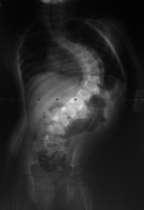 3 year old with presumed idiopathic scoliosis Neurologically nonfocal exam Tethered Cord Tethered Cord MRI