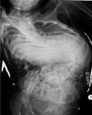 Spine J 2007 Patient KP 15 yo boy with MM and VPS Severe curvature and pelvic obliquity VPS placed at birth and