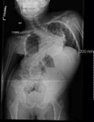 with congenital scoliosis, diastematomyelia Laminectomy and partial resection of