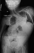 Post-op X-rays Summary Chiari malformation with syrinx should be