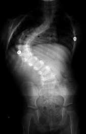 How common is scoliosis with Chiari 1? No.