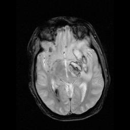 Case 3: fmri: multiple brain lesion