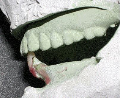 Figure 4 Occlusal view of teeth preparation. Figure 3 Trial set-up, lateral view.