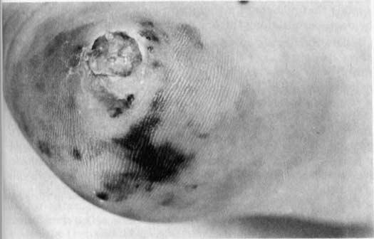 June 1983 ACRAL MELONOMA IN JAPAN FIG 5. Incidence of various types of malignant melanoma at Tohoku University (a) and among Japanese and Caucasians [11] (b). FIG 6. Acral melanoma on the heel.