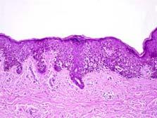 A lentiginous melanoma occurs on