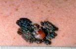 Melanoma Statistics - 2 American Cancer Society Incidence rates for melanoma have been rising for at least 30 years. The lifetime risk of getting melanoma is about 2% (1 in 50) for whites, 0.