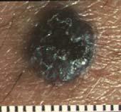 Nodular Melanoma Clinical Features Detectable RGP is absent by definition Tumorigenic melanoma without an adjacent nontumorigenic
