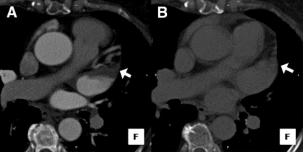 Detection of Left Atrial Appendage Thrombus by Cardiac Computed Tomography: A Word of Caution J Am Coll Cardiol Img. 2009;2(1):77-79. doi:10.