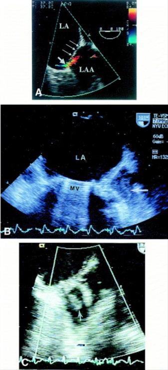 From: Surgical left atrial appendage ligation is frequently incomplete: a transesophageal echocardiographic study J Am Coll Cardiol. 2000;36(2):468-471. doi:10.