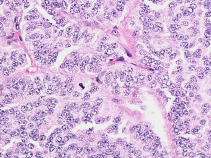 Atypical Carcinoid Very rare, Relatively aggressive Mitoses &