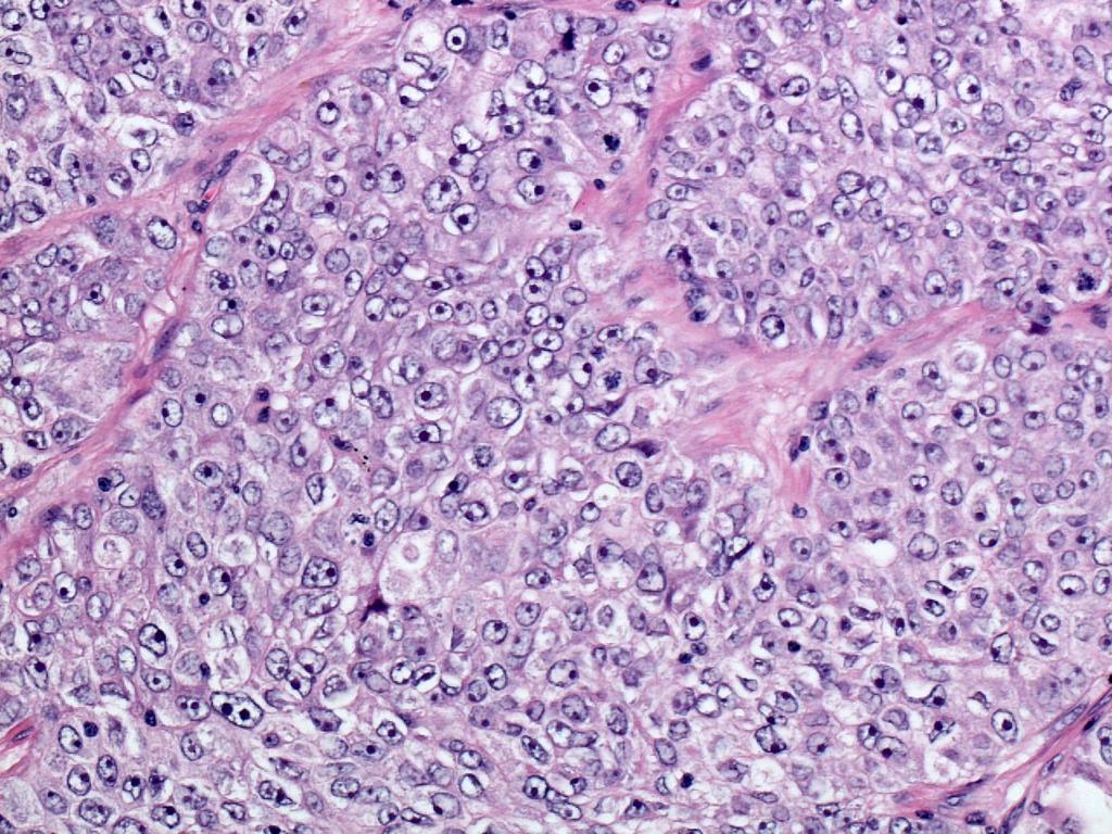 Large Cell Carcinoma ONLY diagnosed on surgical resection NEVER a diagnosis on small biopsy or cytology Most cases (66%)