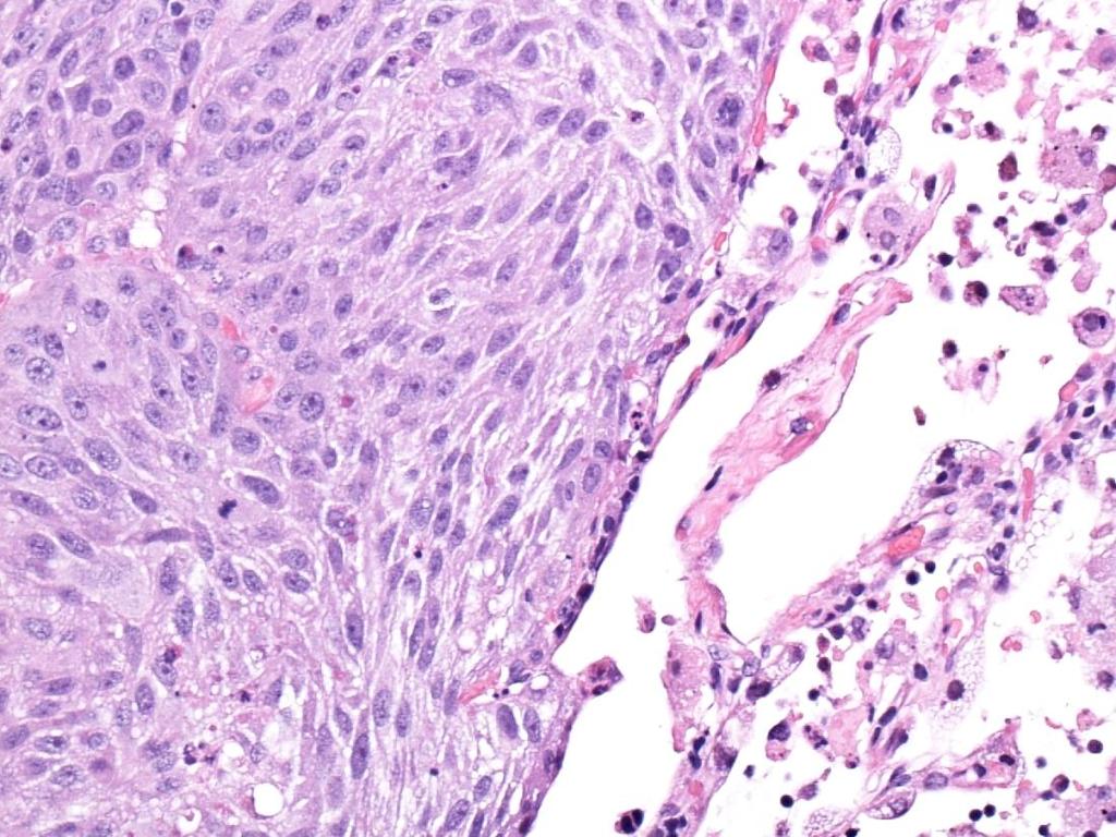 Adenosquamous Carcinoma Relatively rare tumour Relatively aggressive tumour