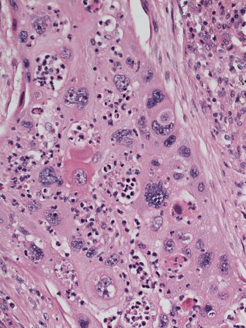 giant cells Usually combined with squamous cell or