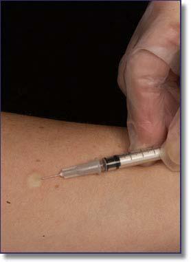 1 ml of PPD Choose site free of scars, tattoos, or abrasions (L forearm) Intra-dermal
