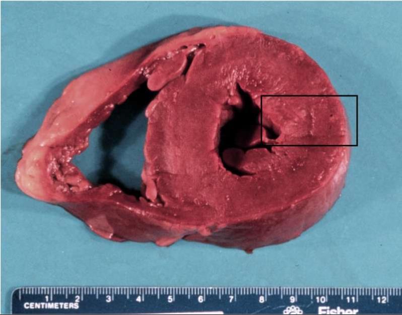 (Photograph of the heart specimen) Normal