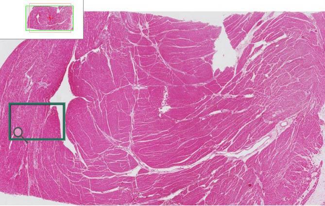 Histological Section of Patient's Heart This is a transmural histological