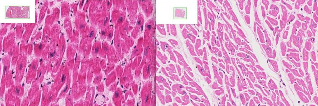Compare the patient's myocardium (on the left) with the normal myocardium (on the right) observed at the same magnification. Study Questions: 1.
