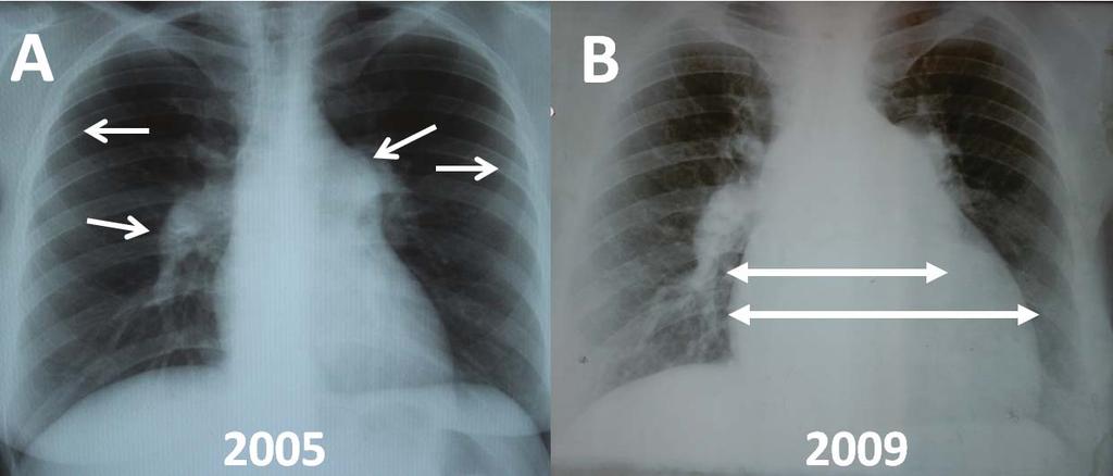 showing the clear lung fields corresponding to olighemia in the peripheral pulmonary circulation; B.