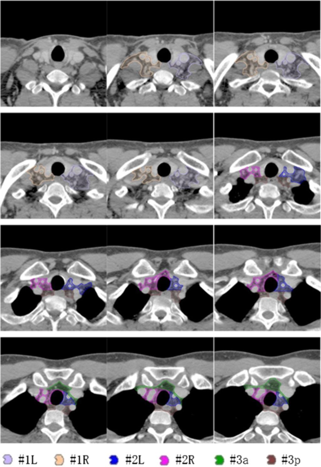 The JLCS-JASTRO consensus-based CT atlas for lung cancer 95 Fig. 13.