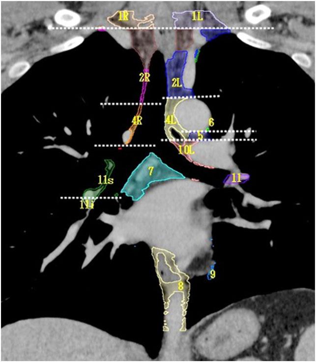 92 T. Itazawa et al. Fig. 1. Coronal view including the carina. Fig. 3. Upper mediastinal cross-section.