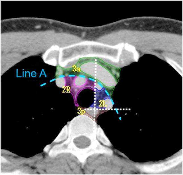 Station 3a: prevascular nodes The cranial border is the upper border of the manubrium (the IASLC definition is the apex of the chest).