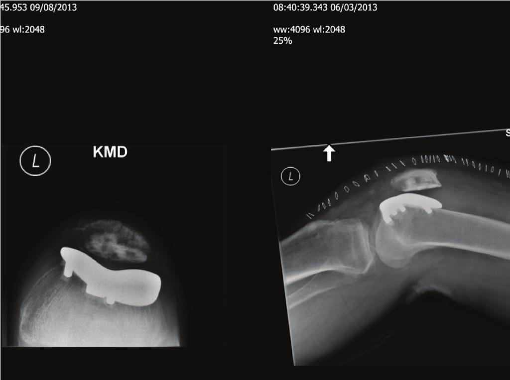 2 Case Reports in Orthopedics Figure 1: Postoperative radiograph of patellofemoral joint replacement.