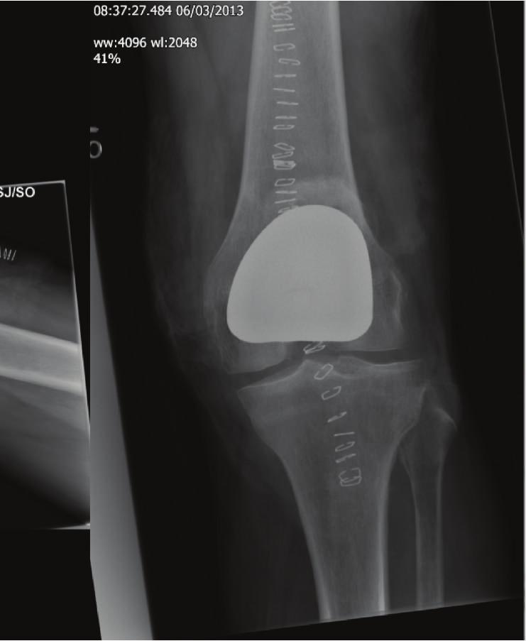 knee system (Figure 3)