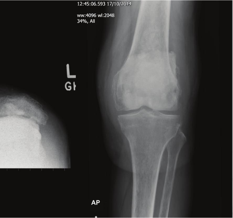 in their systematic review of metal sensitivity in total joint replacement concluded that metal sensitivity testing might be useful in patients with failed joint replacements, especially those with
