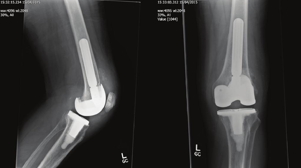Case Reports in Orthopedics 3 Figure 3: Postoperative radiograph of 2nd stage revision with nickel-free prosthesis. of symptoms following implant removal.