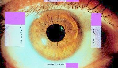 Videokeratograph of the same eye, 5 years after the alloplastic lamellar keratoplasty, shows central corneal flattening and irregular astigmatism.