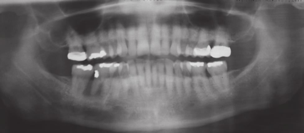 2 Case Reports in Dentistry tenderness, swelling, and/or the presence of a sinus tract. The appropriate treatment methods for retrograde periimplantitis are still unclear [9, 10]. Kim et al.