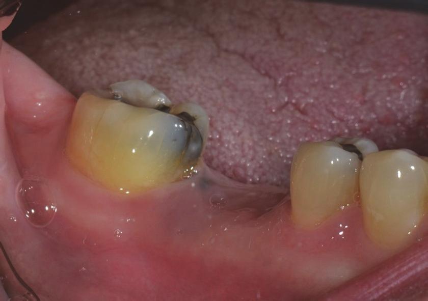 Case Reports in Dentistry 3 Figure 2: Preoperative views: intraoral; periapical radiograph.