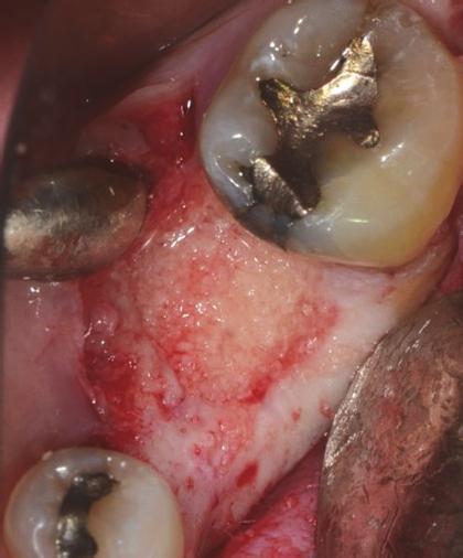 interrupted sutures (f). precluded the placement of a dental implant in that site.