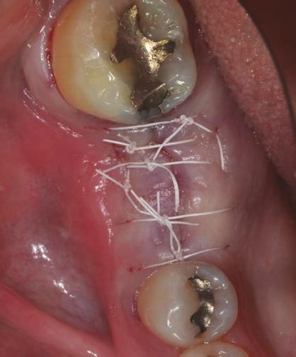 erratic healing, whereas mandibular molar sites had the highest prevalence.