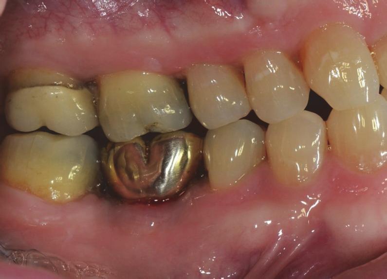 Case Reports in Dentistry 5 Figure 6: One-year follow-up after crown delivery. There is no evidence of inflammation or symptoms.