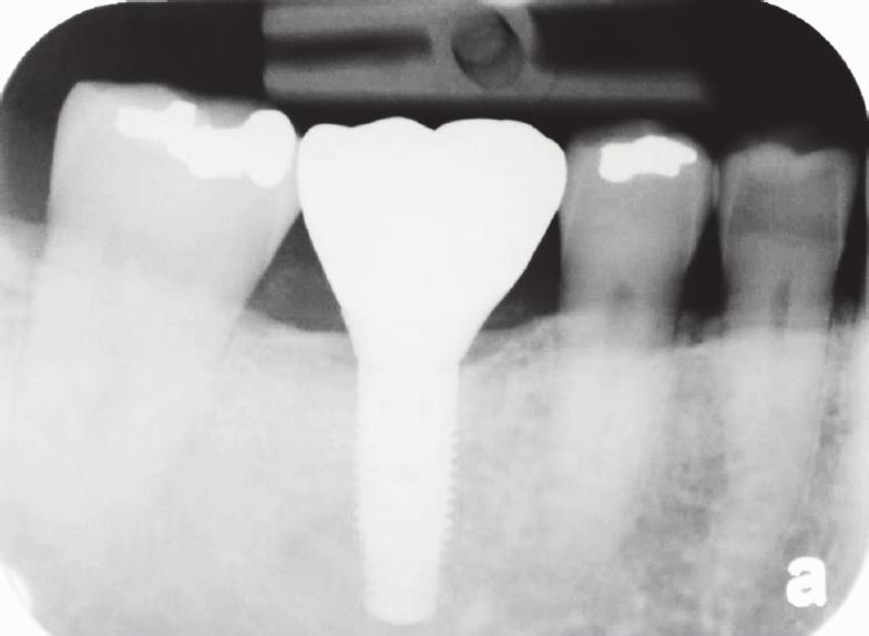 Maxillofacial Radiology (AAOMR) published a position statement regarding CBCT for dental implantology.