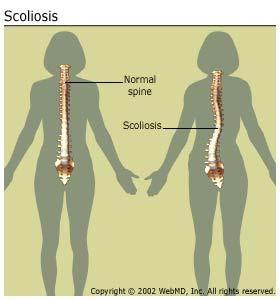 Fig 1:This is an S shaped scoliosis