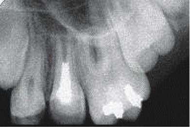 Andreason JO, Hjorting- Hansen R. Intra-alveolar root fractures: radiographic and histologic study of 50 cases. J Oral Surg 1967;25:414-26 22. Giuliani V, Baccetti T, Pace R, Pagavino G.