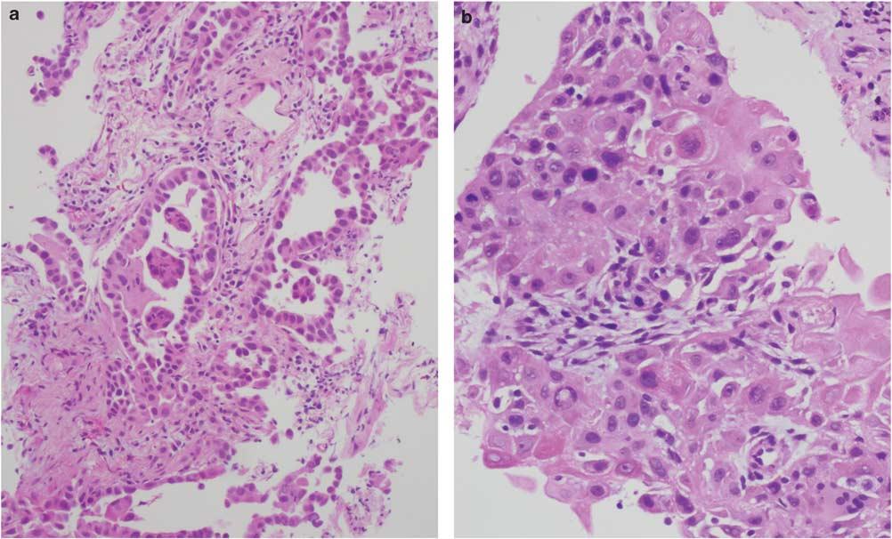 S44 Small biopsies of lung nodules endothelial growth factor inhibitor bevacizumab has been associated with an increased incidence of lifethreatening hemoptysis in patients with squamous cell