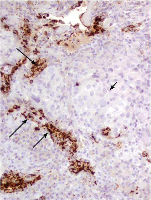 Small biopsies of lung nodules S49 carcinoma subclassification.